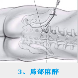 采取局部麻醉方式進行麻醉