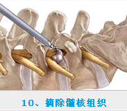 椎間孔鏡價格怎么樣