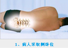 椎間孔鏡手術需要的臥位姿勢