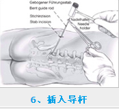 椎間孔鏡術后護理